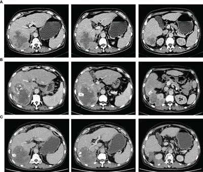 Surgery after combination therapy with a tyrosine kinase inhibitor and anti-PD-1 antibody in sarcomatoid hepatocellular carcinoma: case report and literature review